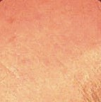 Age Spot Removal After