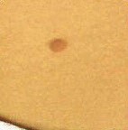 Mole Removal Before