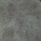 Red Vein Removal After